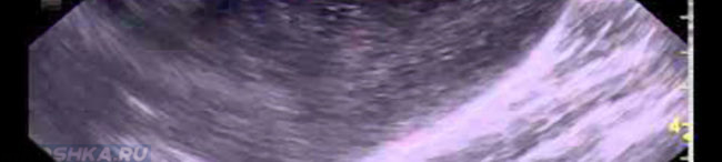 Воспаление мочевого пузыря у кот на снимке УЗИ