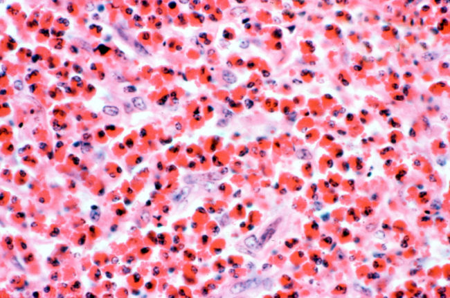 Клетки эозинофилы под микроскопом