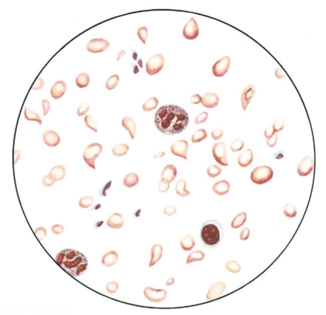 Картина крови при анемии в виде рисунка