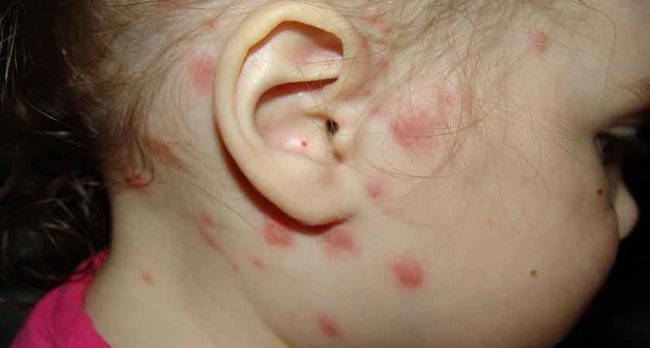 Красные пятна на коже ребенка при раздражении от укуса блох